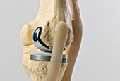 Implantable Devices
